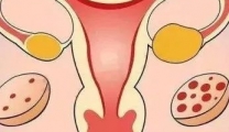 大姨妈任性、肥胖爱长痘、怀孕难……烦人的多囊卵巢综合征！