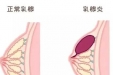 女性乳房出现这5种变化或是乳腺的