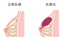 女性乳房出现这5种变化或是乳腺的