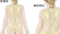 孩子高低肩、驼背、双下肢不等长，仁爱儿推专家说警惕脊柱侧弯